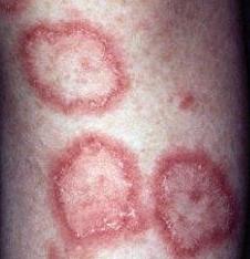 lupus eritematoso discoide dermoscopia